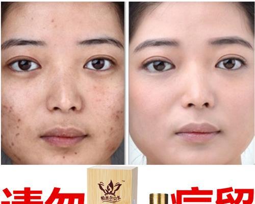 快速祛痘疤的有效方法（让你迅速摆脱痘疤困扰）