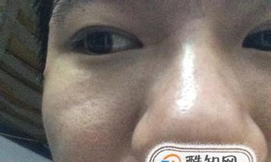 解决脸上毛孔粗大的有效方法（去除毛孔问题）