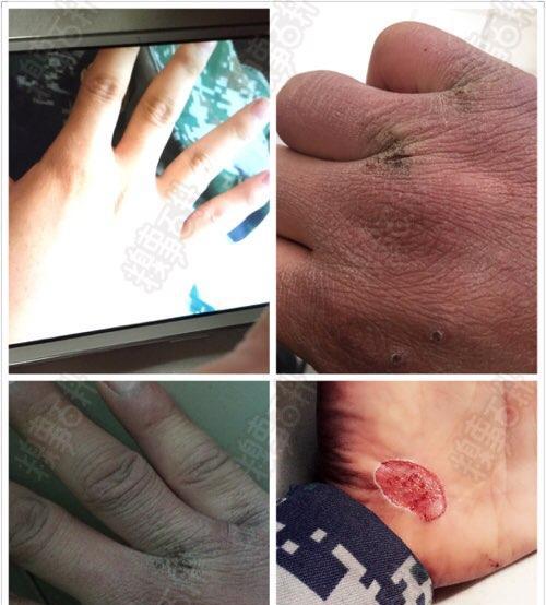 疤痕对兵役资格的影响（为何有疤痕者不能当兵）