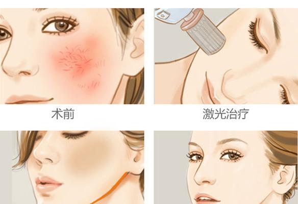 皮肤为什么会有红血丝？如何有效改善和预防？