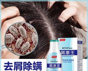 头痒头皮屑多怎么办？有效解决头皮问题的方法是什么？