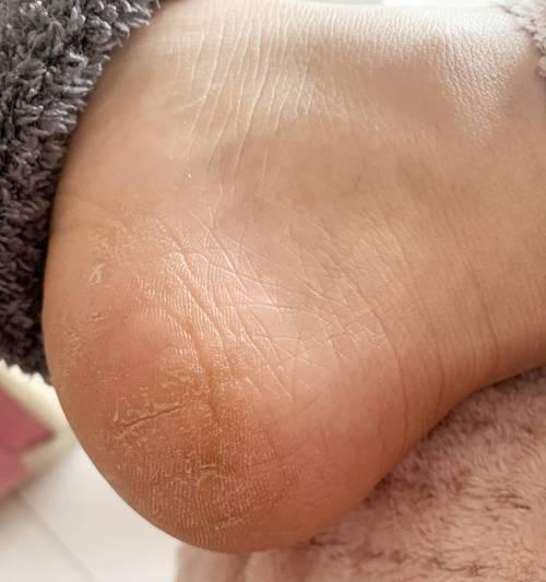 脚后跟干裂起硬皮怎么办？有效家庭护理方法是什么？
