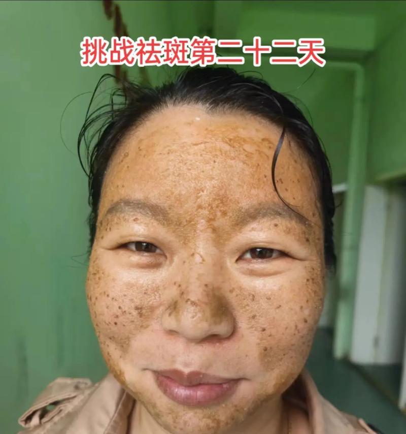 手机拍照时雀斑如何美化？有哪些技巧可以减少雀斑？