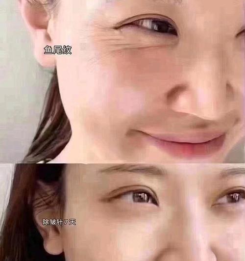 如何有效去除鱼尾纹和皱纹（护肤方法与注意事项）