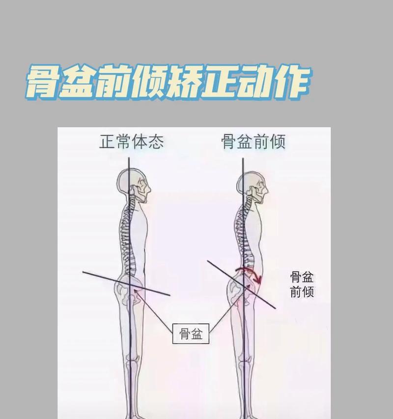 骨盆前倾最快纠正法（解析骨盆前倾的原因及快速矫正方法）